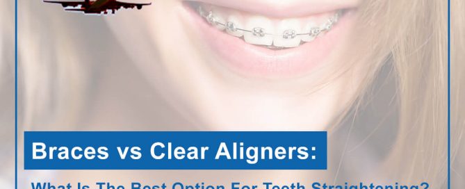 Braces vs Clear Aligners: What Is The Best Option For Teeth Straightening?