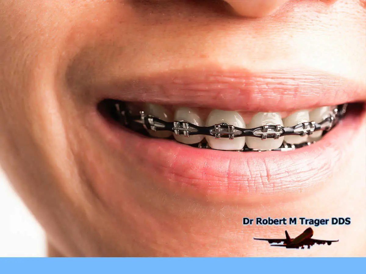 Advantages Of Ceramic Braces To Straighten Your Teeth